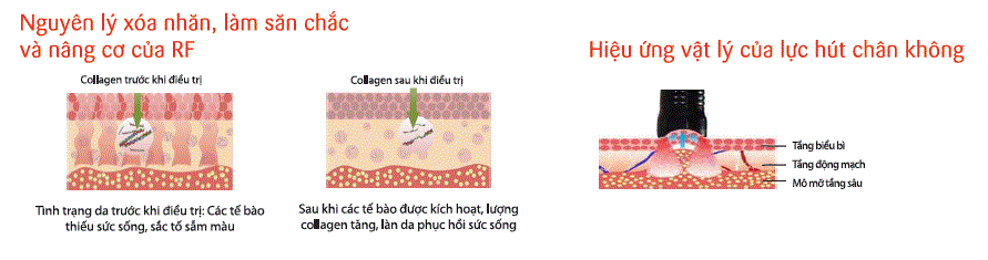 cong-nghe-giam-beo-max-burn-lipo